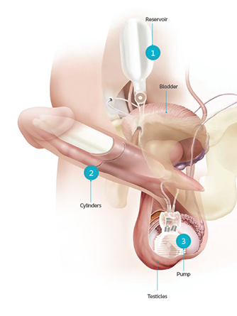 3 Piece Implant