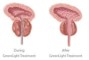 Greenlight Before and After