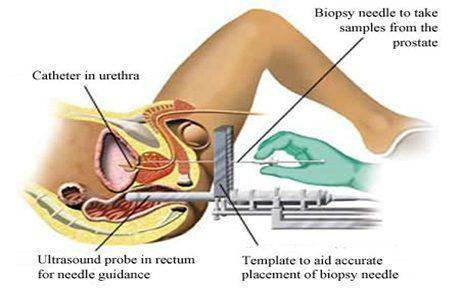 Transperineal Biopsy