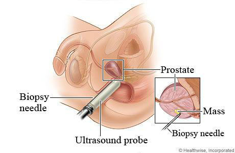 Biopsy on prostate