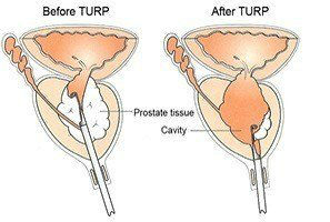 Turp Before & After