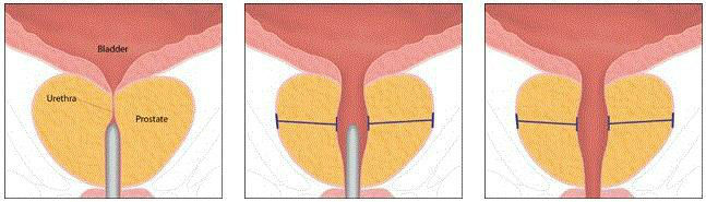 Urolift Procedure