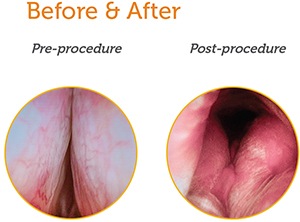 UroLift® System Procedure